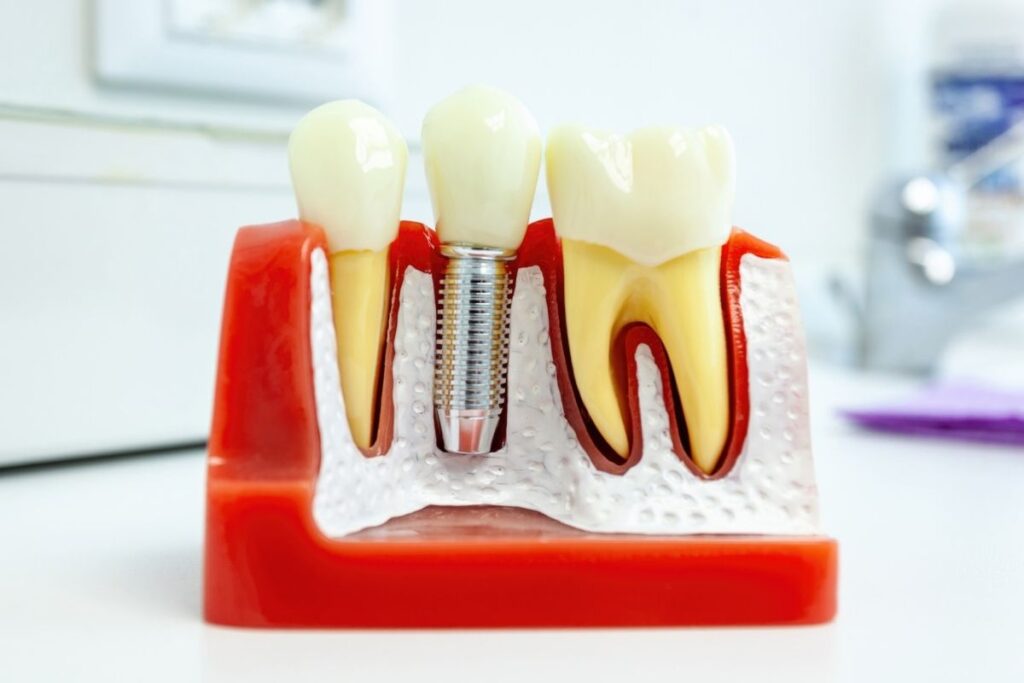 Dental Implants Near Me