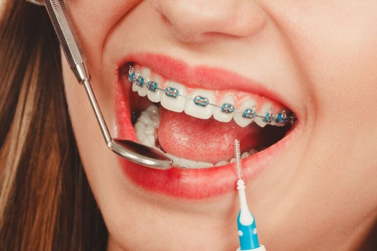 Dental Braces in Antalya