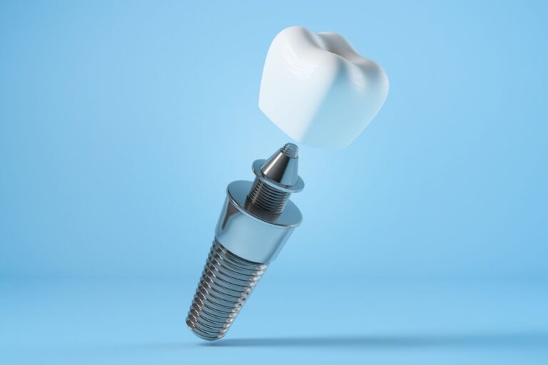 What is dental implants
