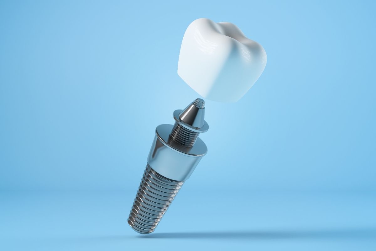 What is dental implants