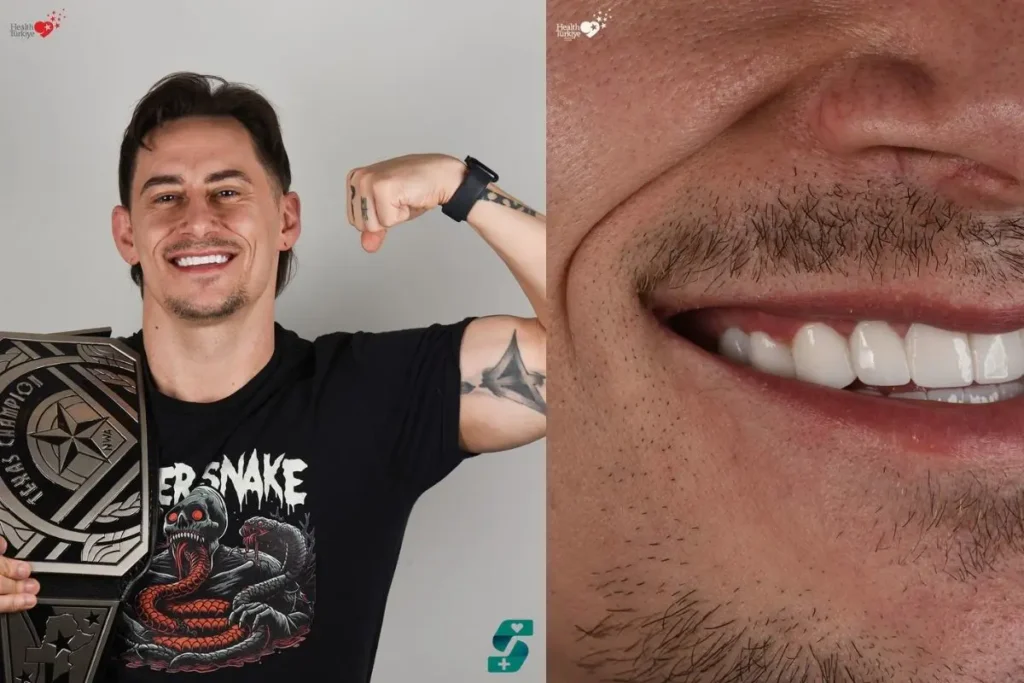 Dental Veneers Antalya