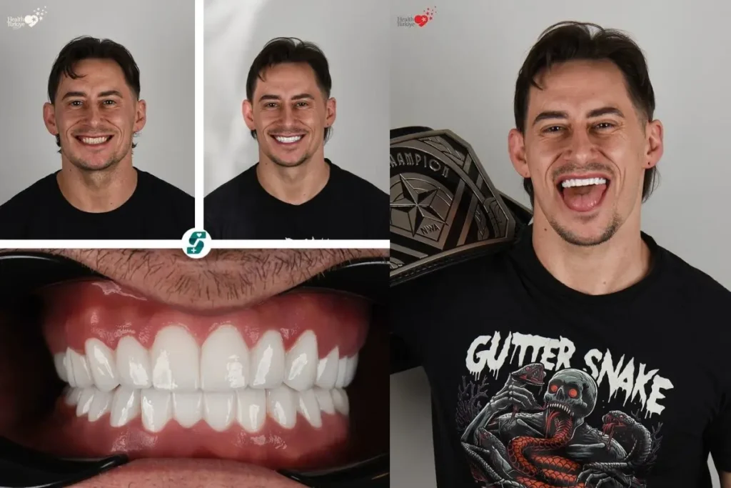 Dental Veneers in Antalya